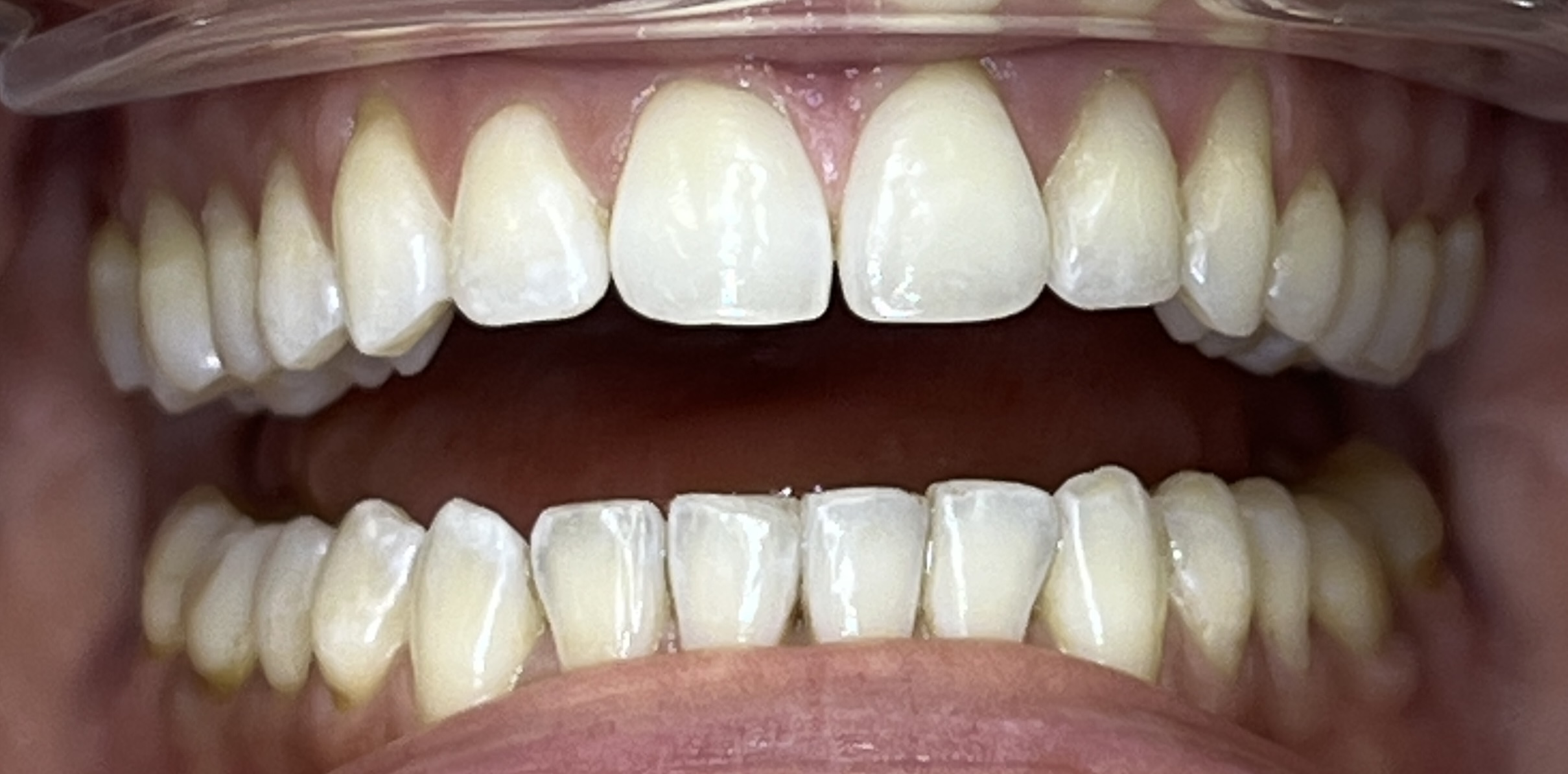 Close-up of Anhelina's teeth after Invisalign
