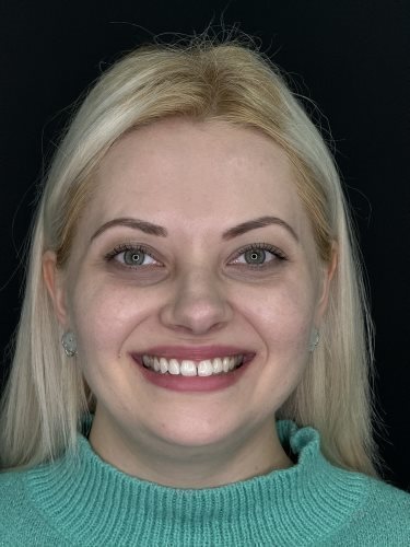 Anhelina smiling before Invisalign treatment
