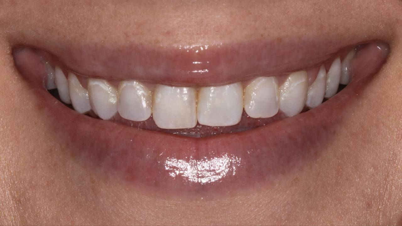 Before Smile Sculpt — mottled, discolored enamel with uneven staining prior to treatment