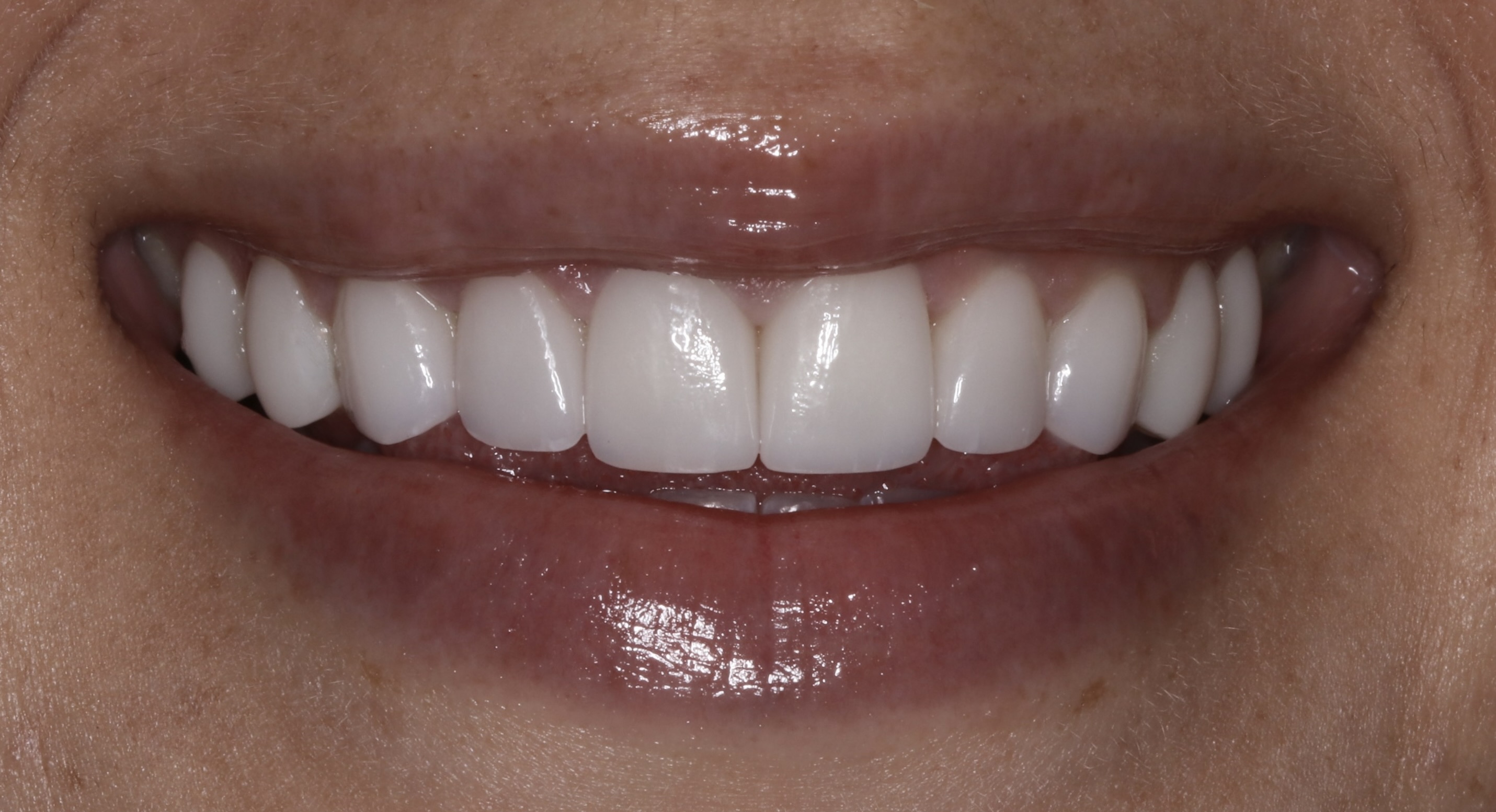 After Smile Sculpt — mottled discoloration fully corrected with bright, even hybrid veneers