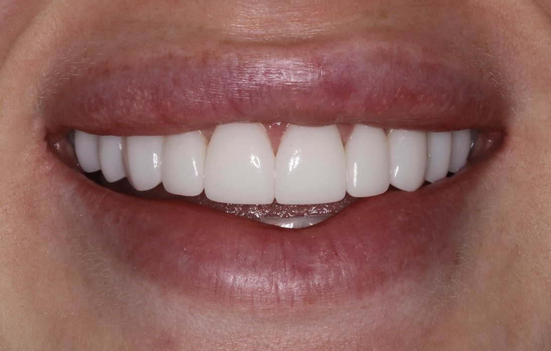 After Smile Sculpt — flat and worn teeth reshaped to whiter, fuller, even contour