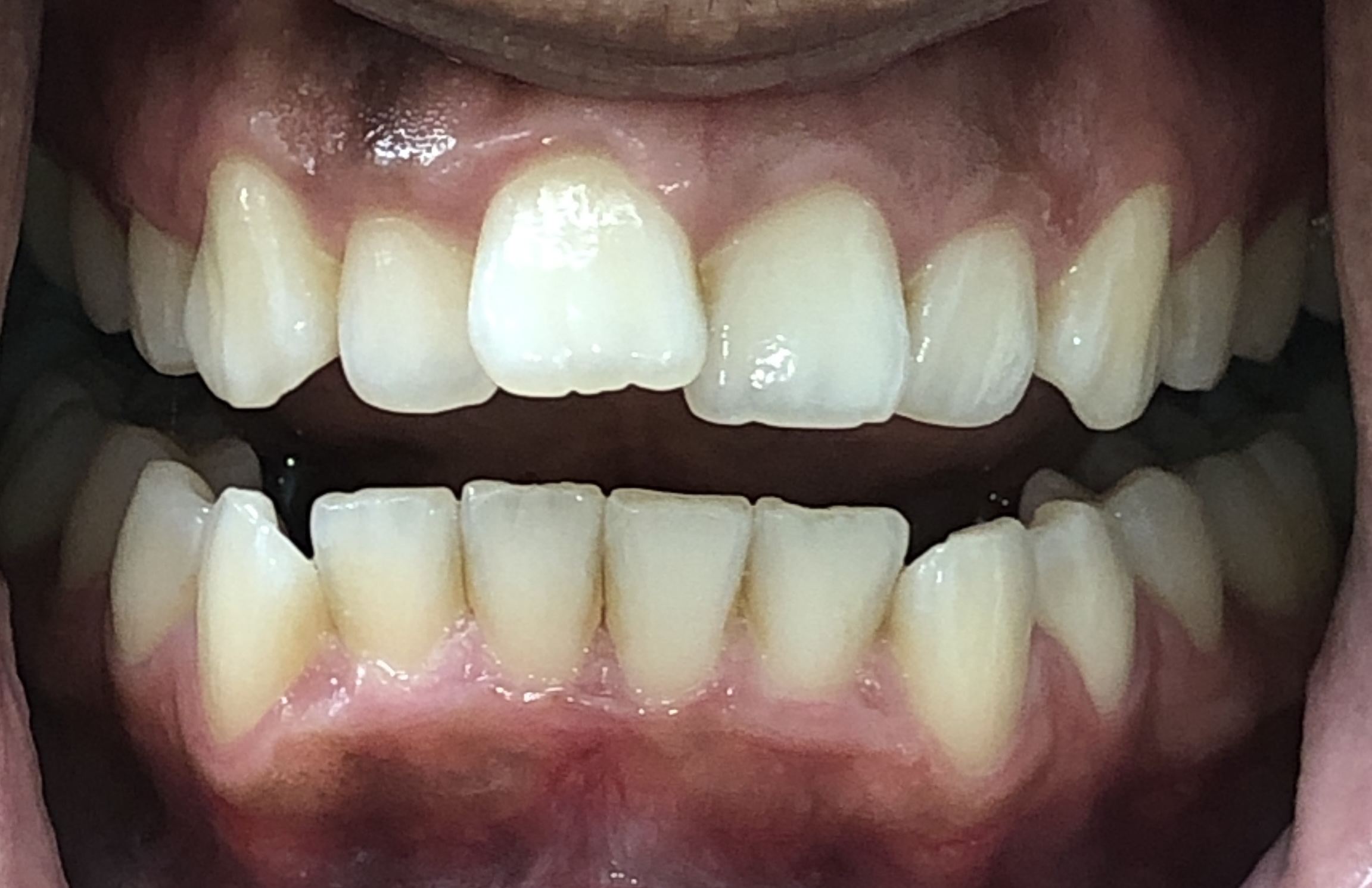 Close-up of Jennifer's teeth before Invisalign