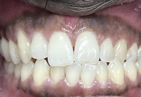 Close-up of Kent's teeth before Invisalign