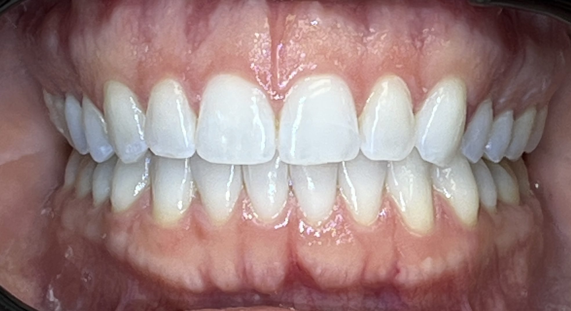 Close-up of Mallory's teeth after Invisalign