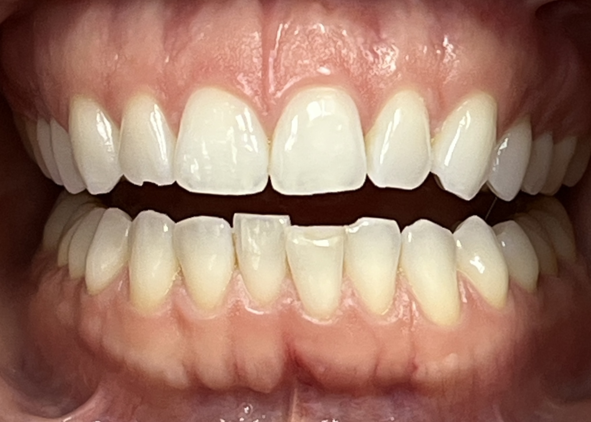 Close-up of Mallory's teeth before Invisalign