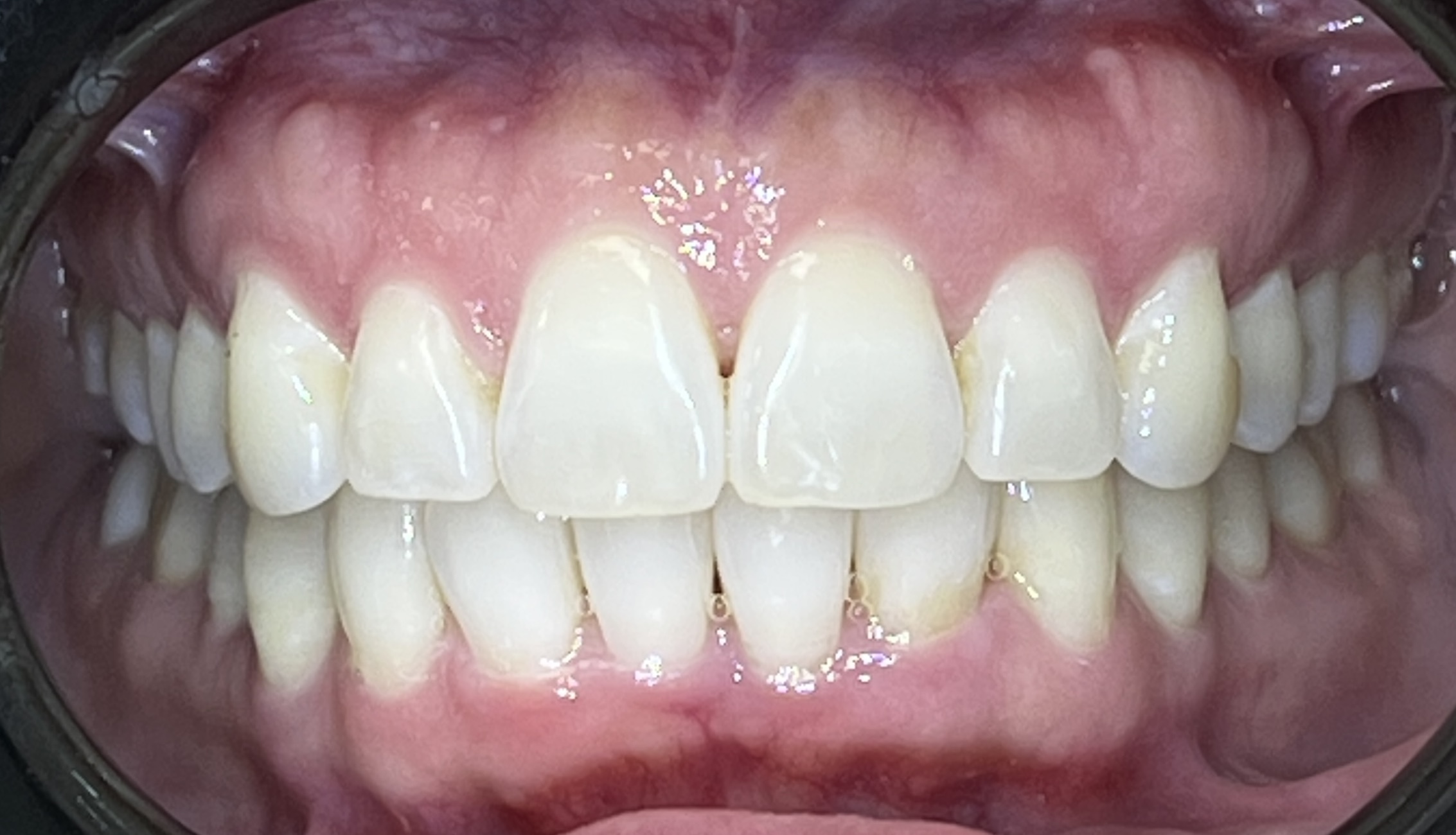 Close-up of Rebecca's teeth after Invisalign