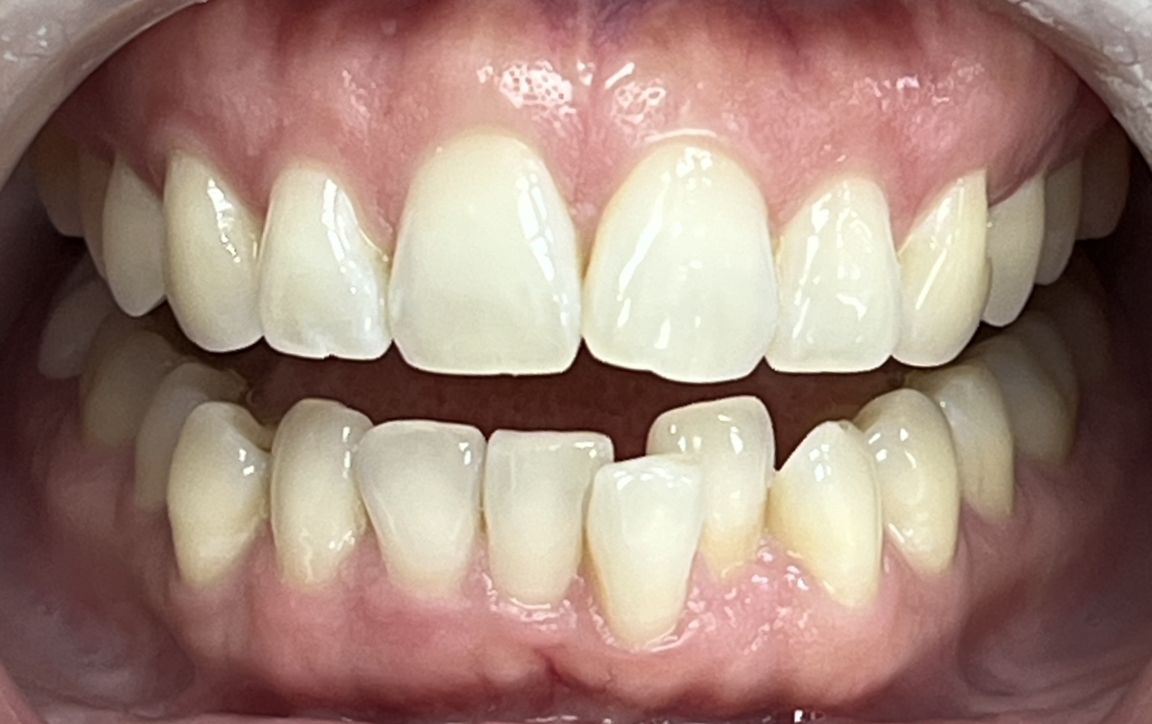 Close-up of Rebecca's teeth before Invisalign