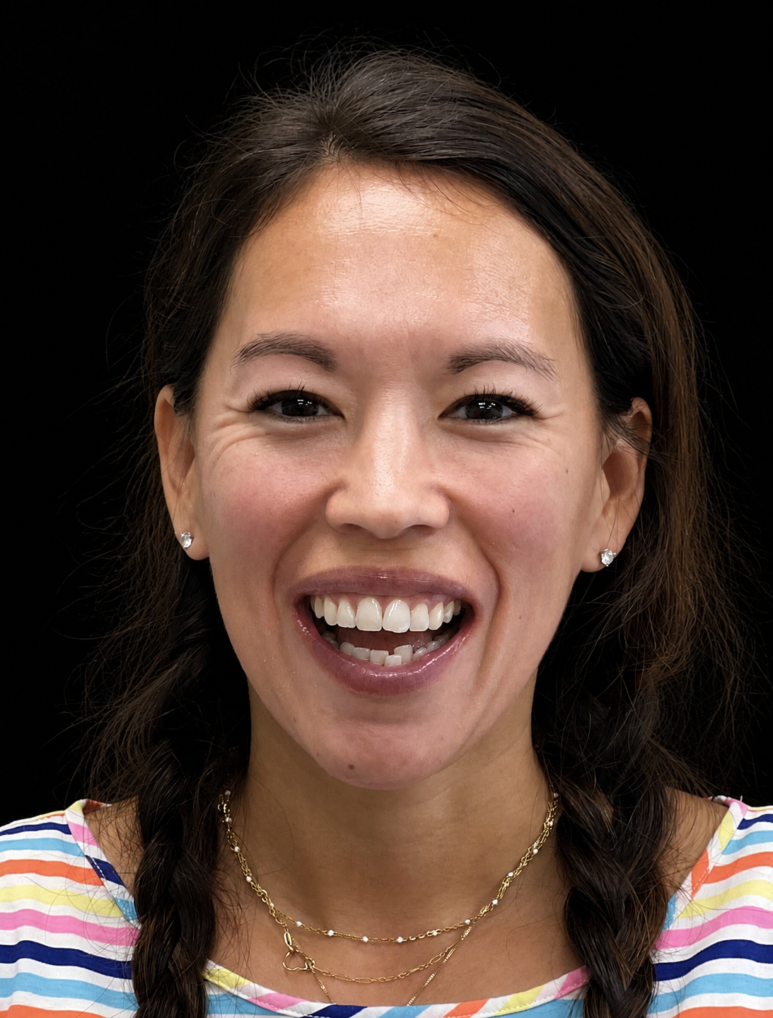 Rebecca smiling before Invisalign treatment