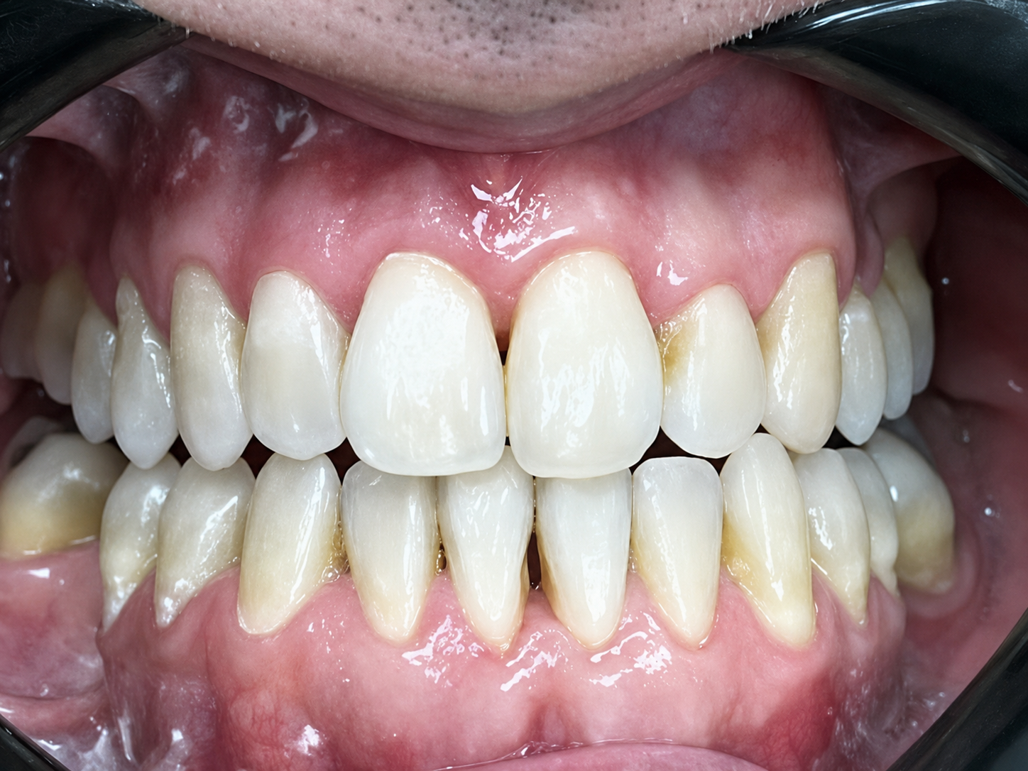 Close-up of Robert's teeth after Invisalign