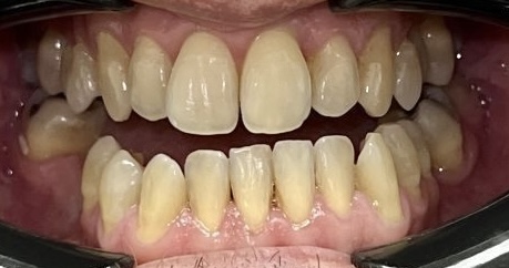 Close-up of Robert's teeth before Invisalign