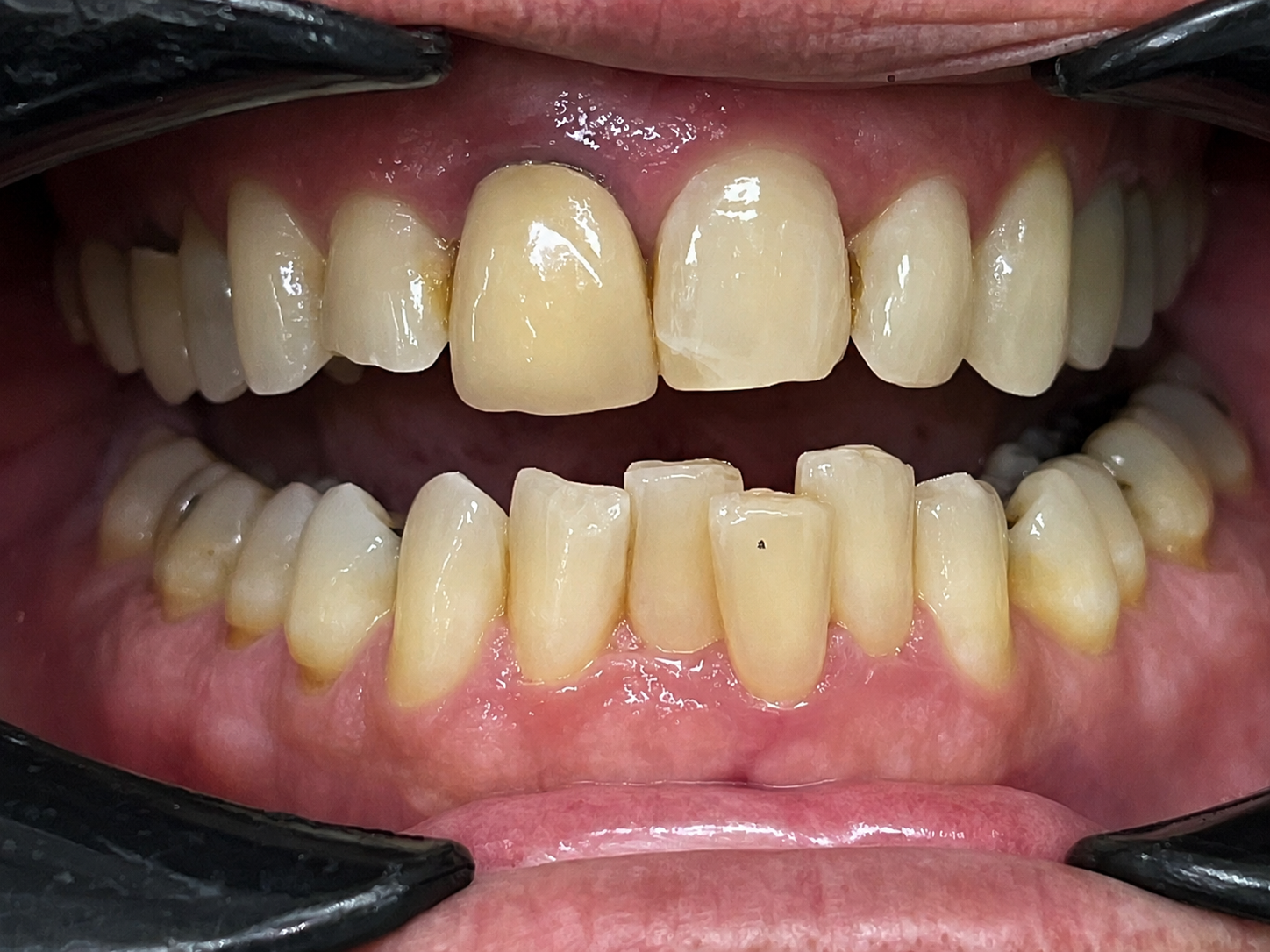Close-up of Steven's teeth before Invisalign