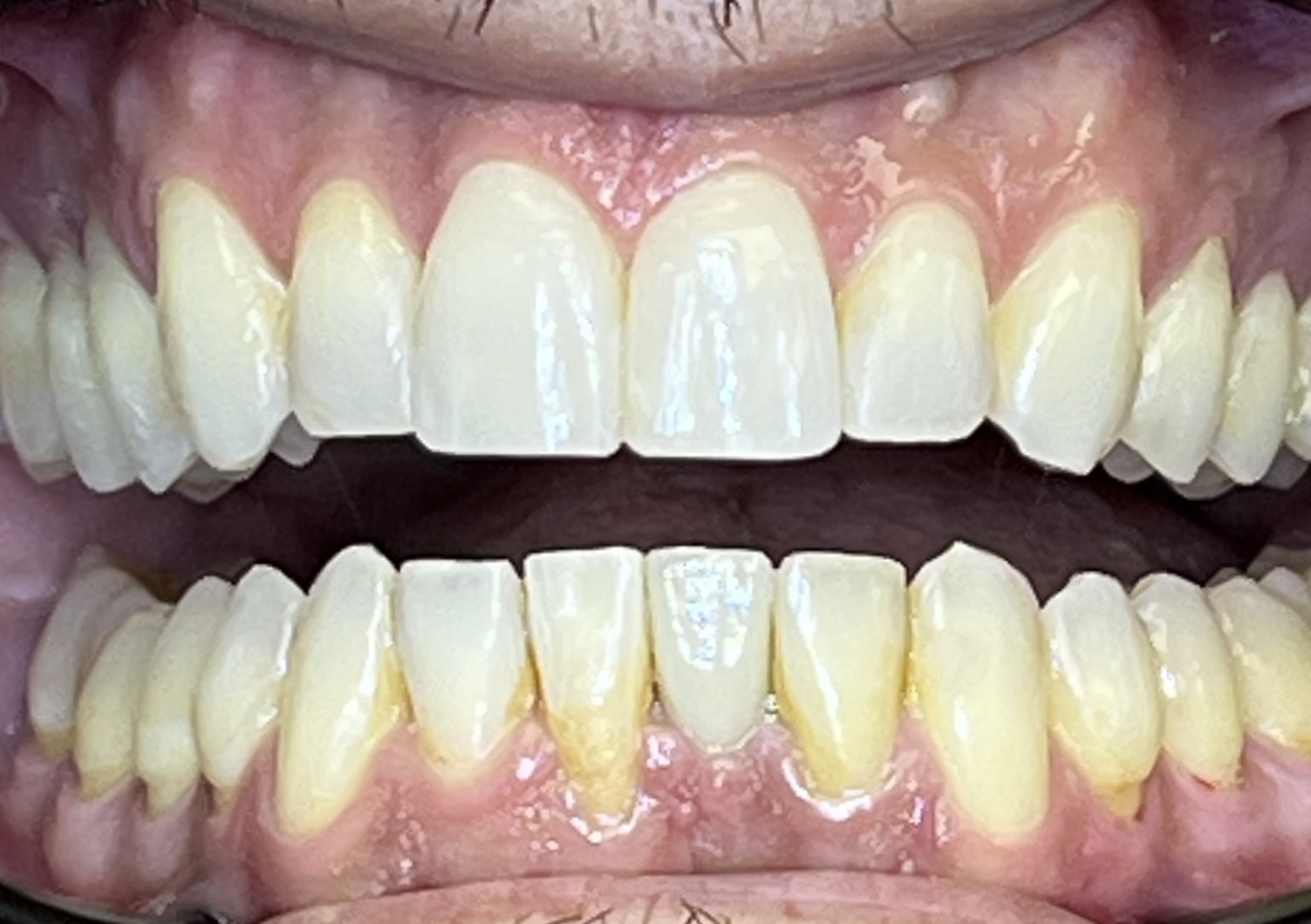 Close-up of Wilfredo's teeth after Invisalign