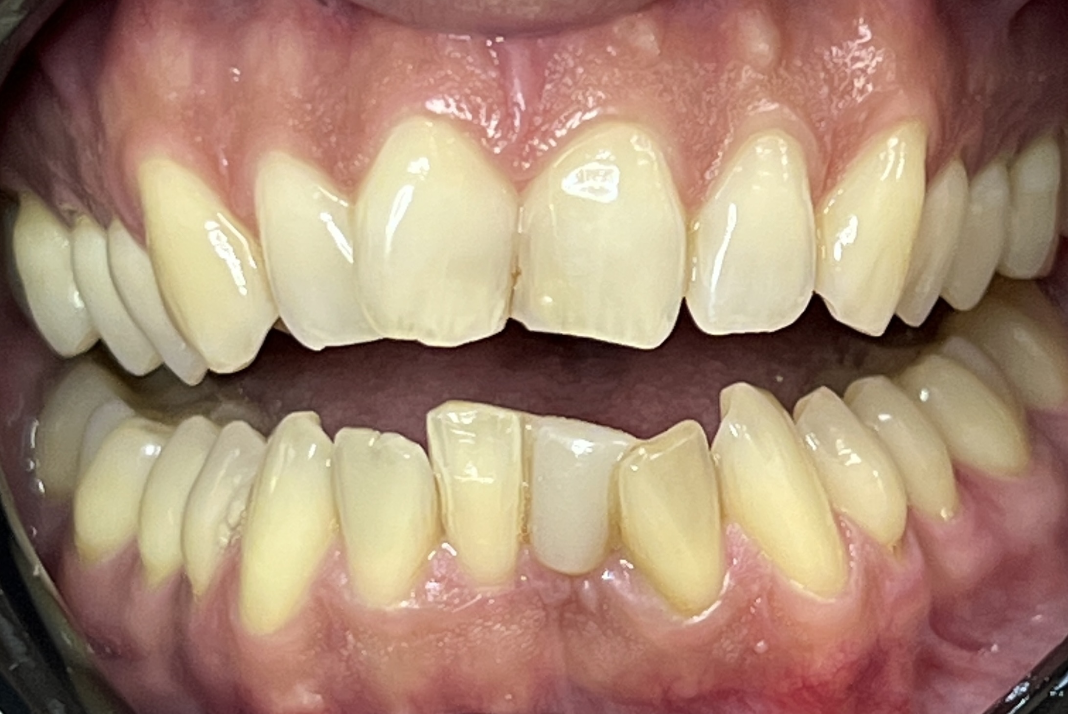 Close-up of Wilfredo's teeth before Invisalign